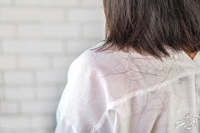 علت ریزش مو